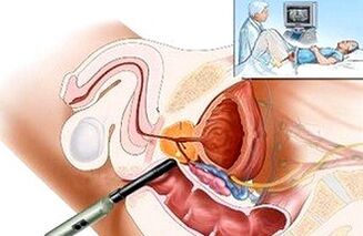 Ways of diagnosing prostatitis
