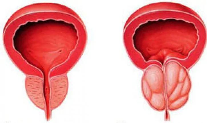 Normal prostate (left) and chronic inflamed prostatitis (right)