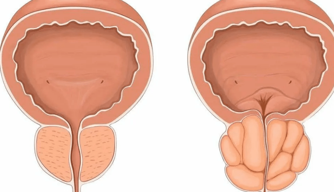 healthy and diseased prostate